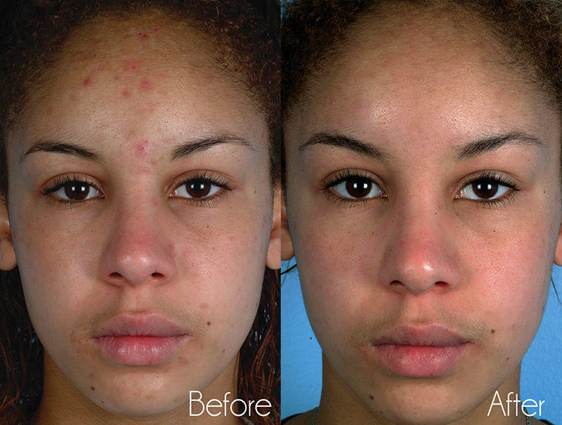 Kingdom Royale Spa Services - Microdermabrasion Facial