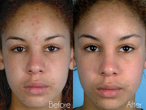 Kingdom Royale Spa Services - Microdermabrasion Facial