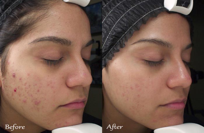 Kingdom Royale Spa Services - Goddess Mummy Peel Treatment
