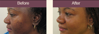 Kingdom Royale Spa Services - Dermaplaning